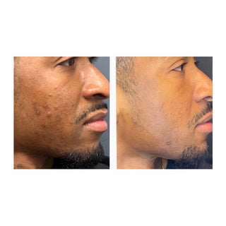 The Acne System